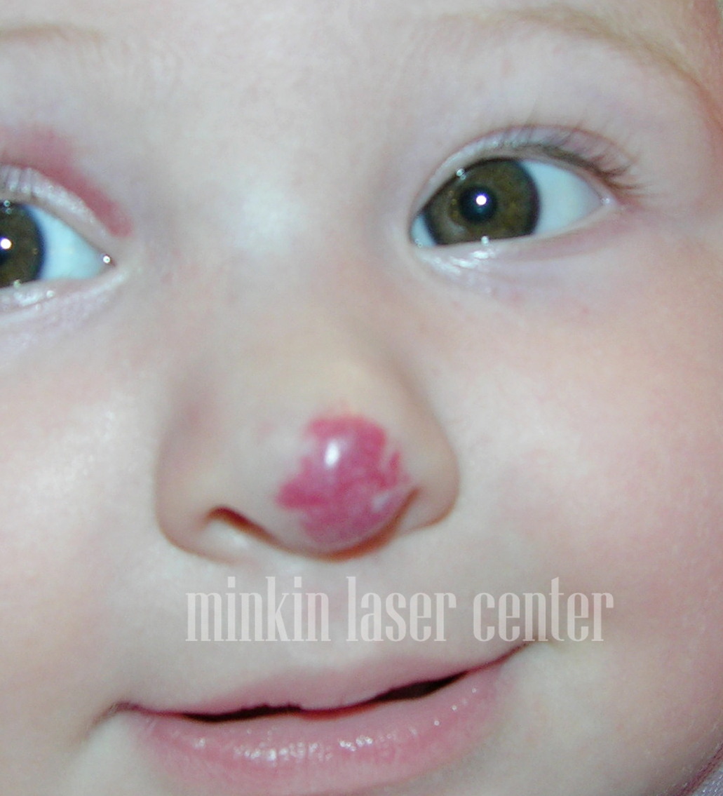 Младенческая гемангиома носа